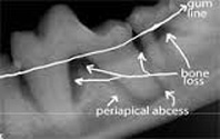Periodontal Disease Image 7